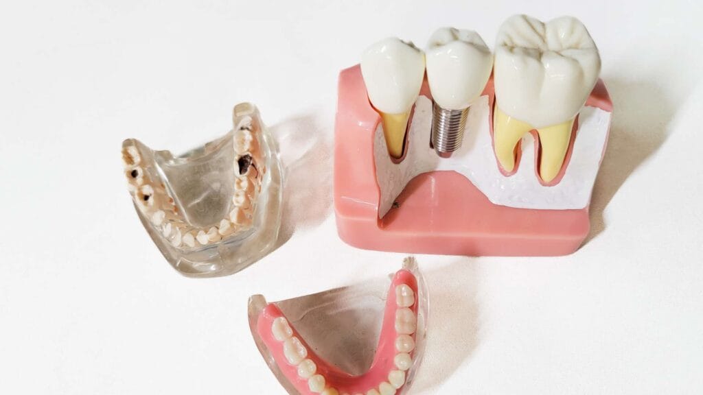 quanto dura un impianto dentale | durata | dentalian - Impianto dentale vicino a me
