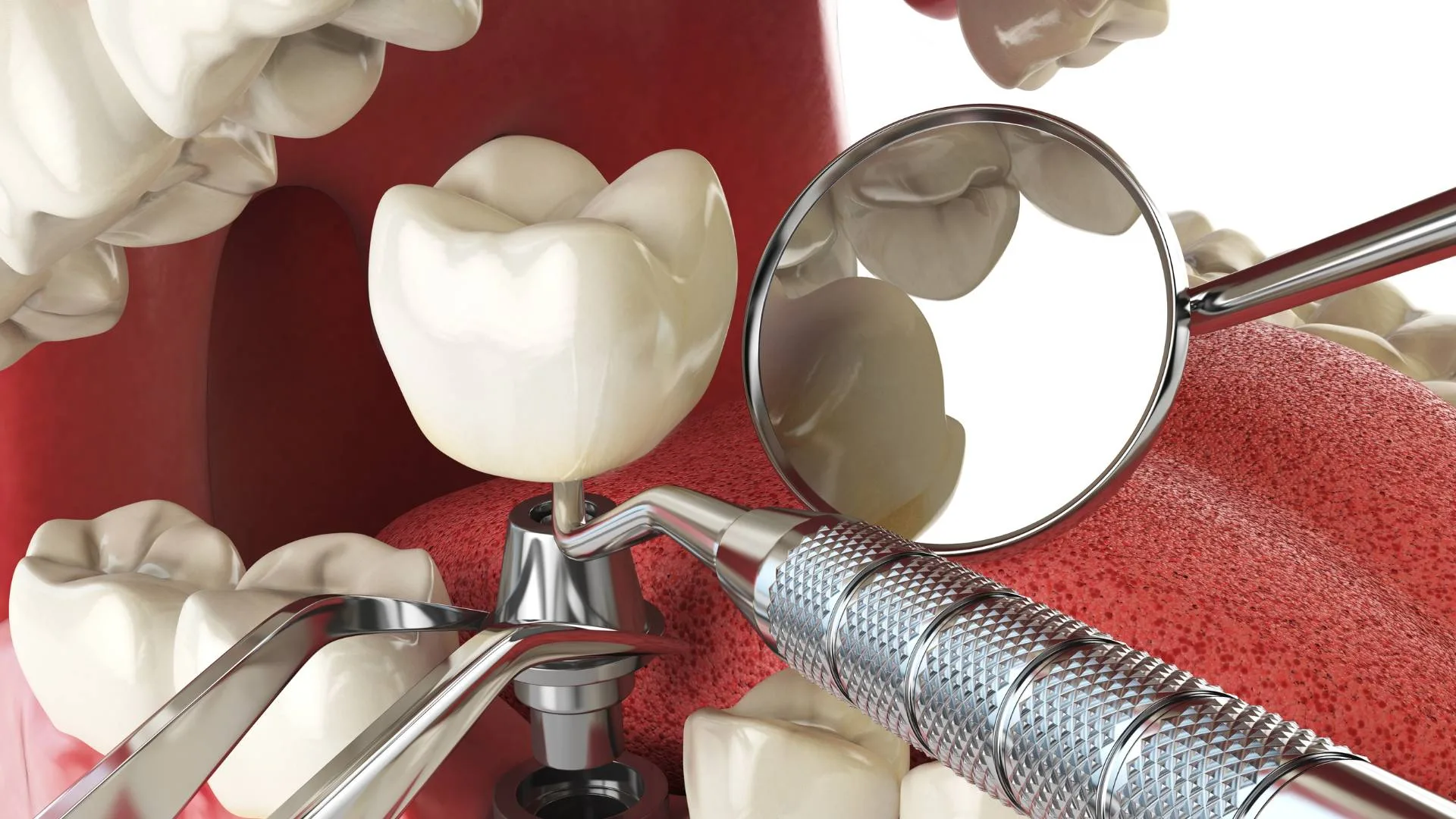 impianto dentale 3 | impiantodentaledentista.it