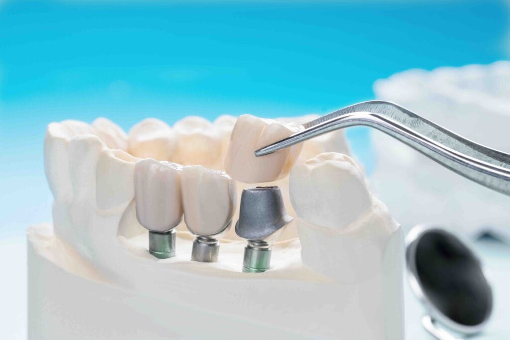 Cosa mangiare dopo aver fatto un impianto dentale