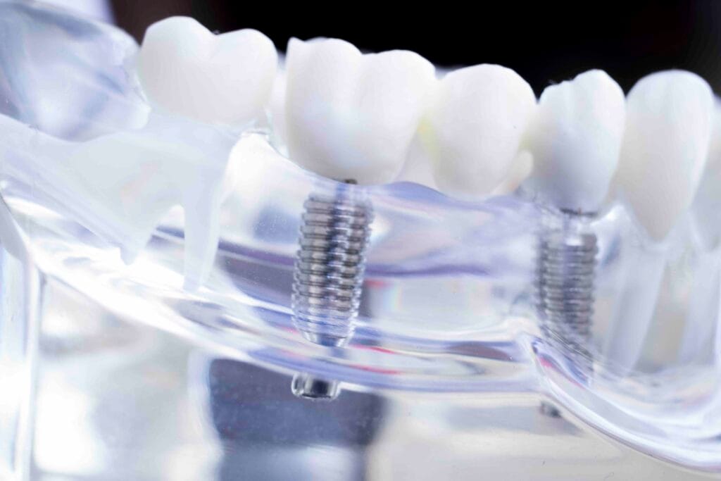 Cosa fare dopo un impianto dentale