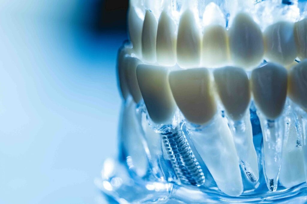 Cosa sono gli impianti dentali