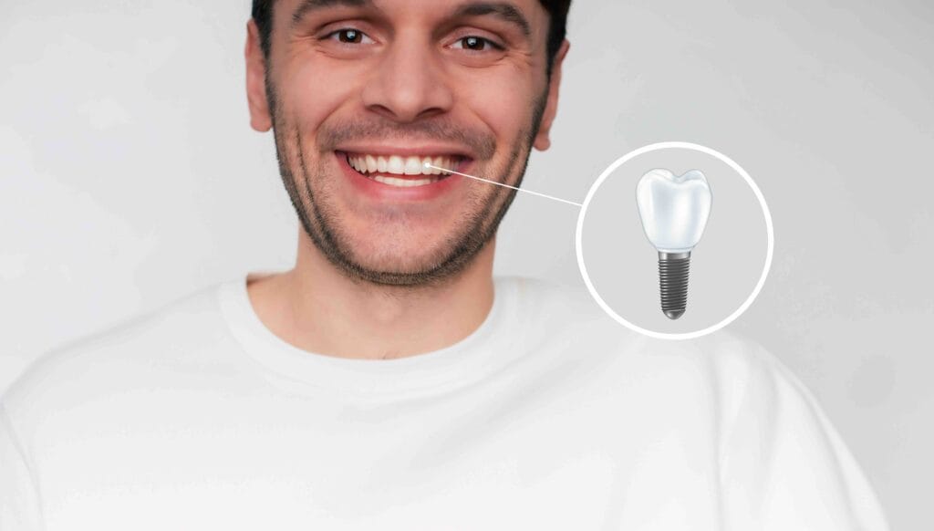 Impianto dentale a Milano