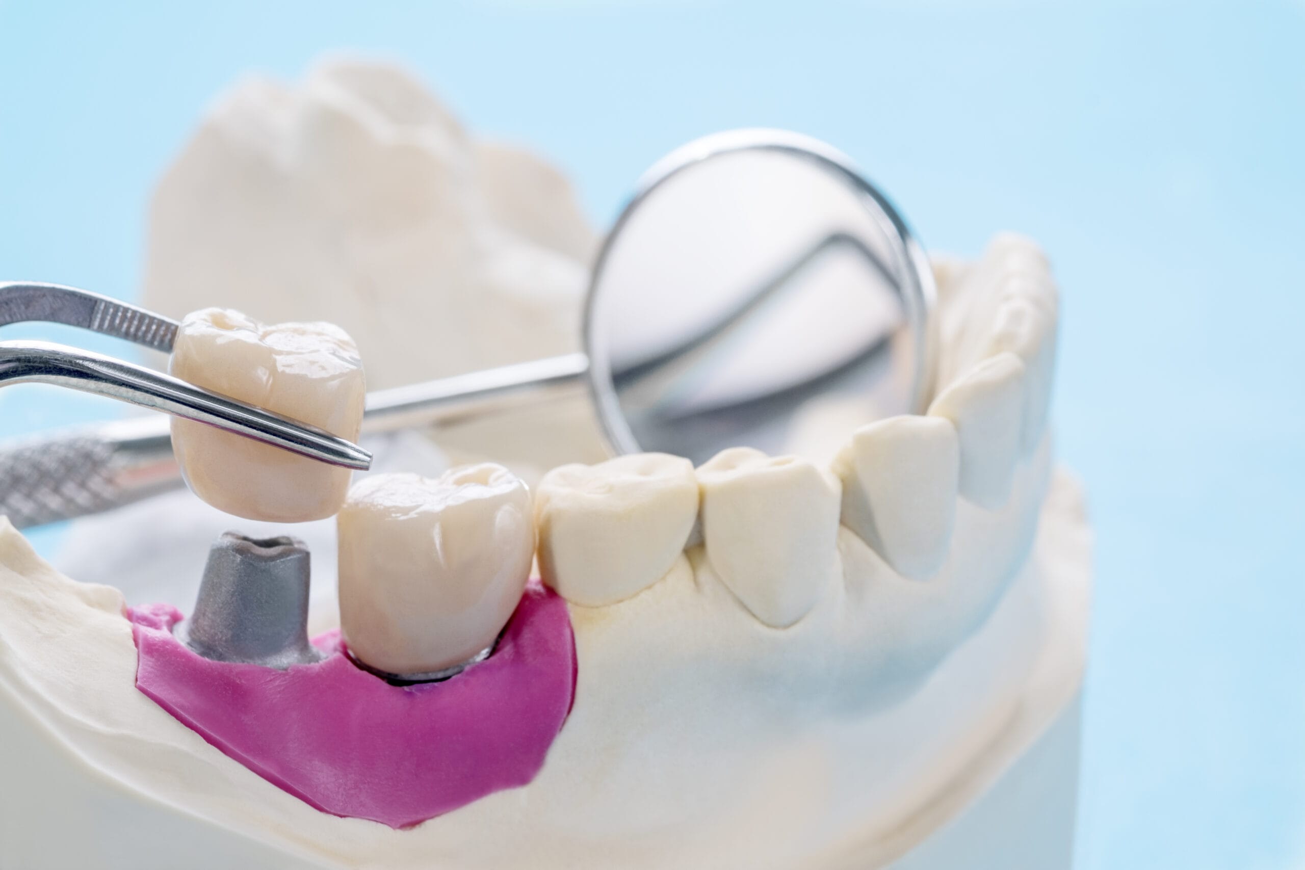 Impianto dentale a Anzola dell’emilia