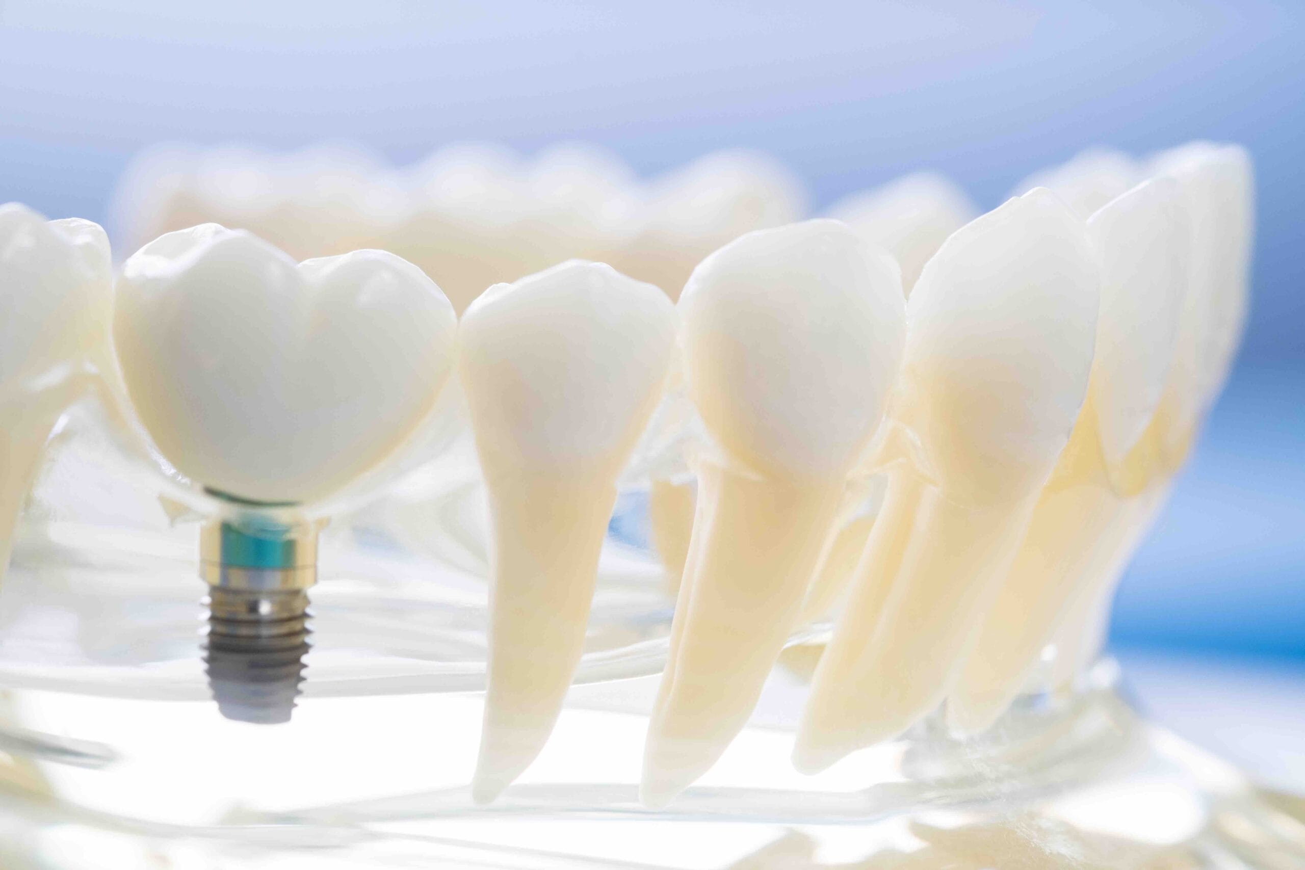 Come mantenere gli impianti dentali