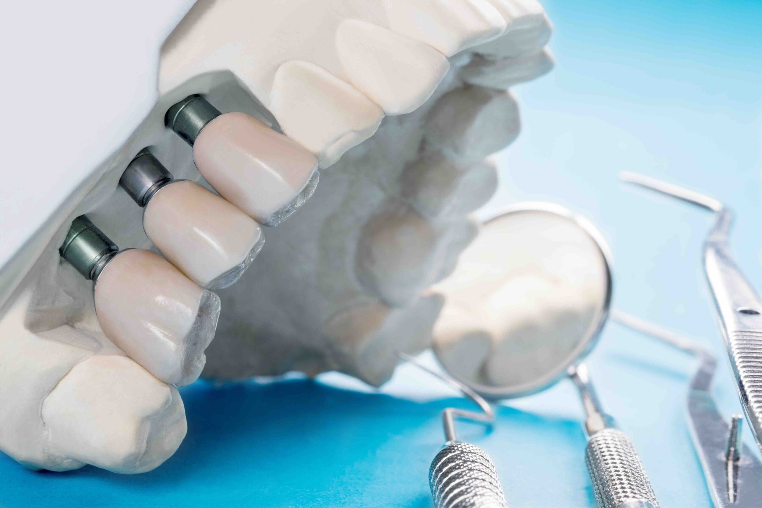 cos’è un impianto dentale