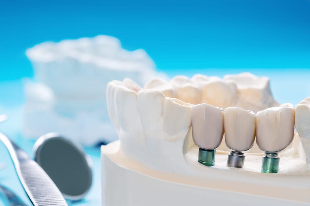 dolore dopo gli impianti dentali