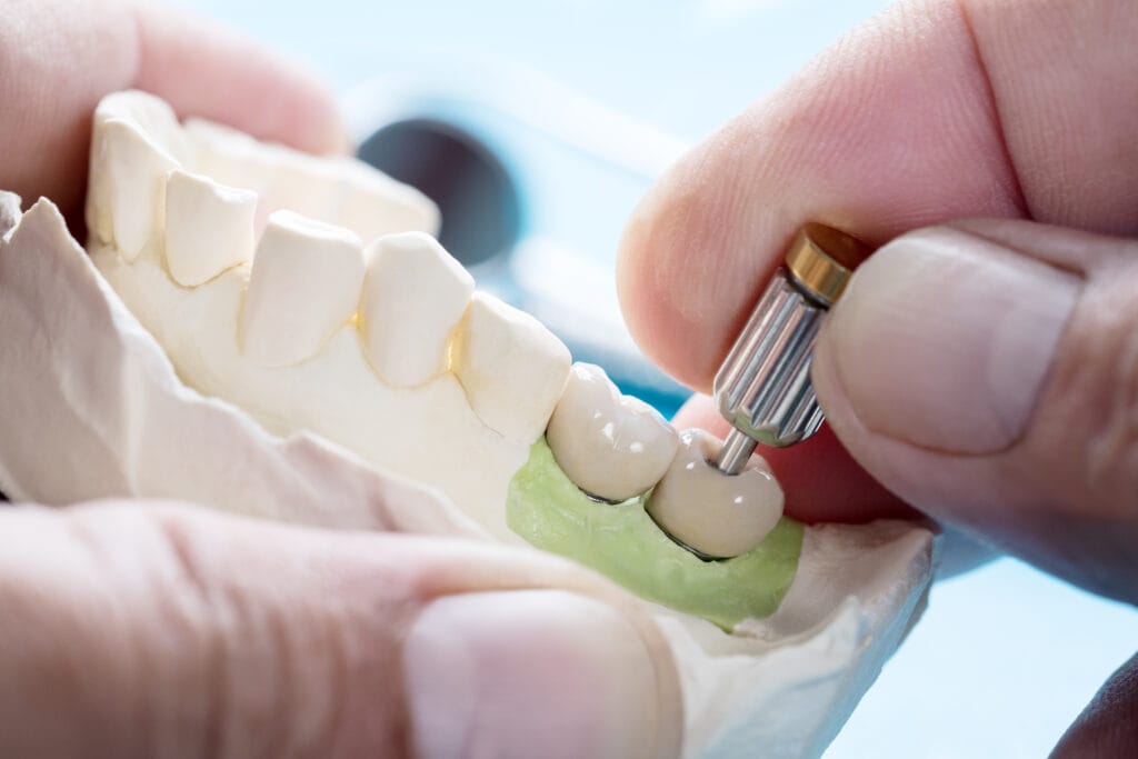 errori post inserimento impianti dentali