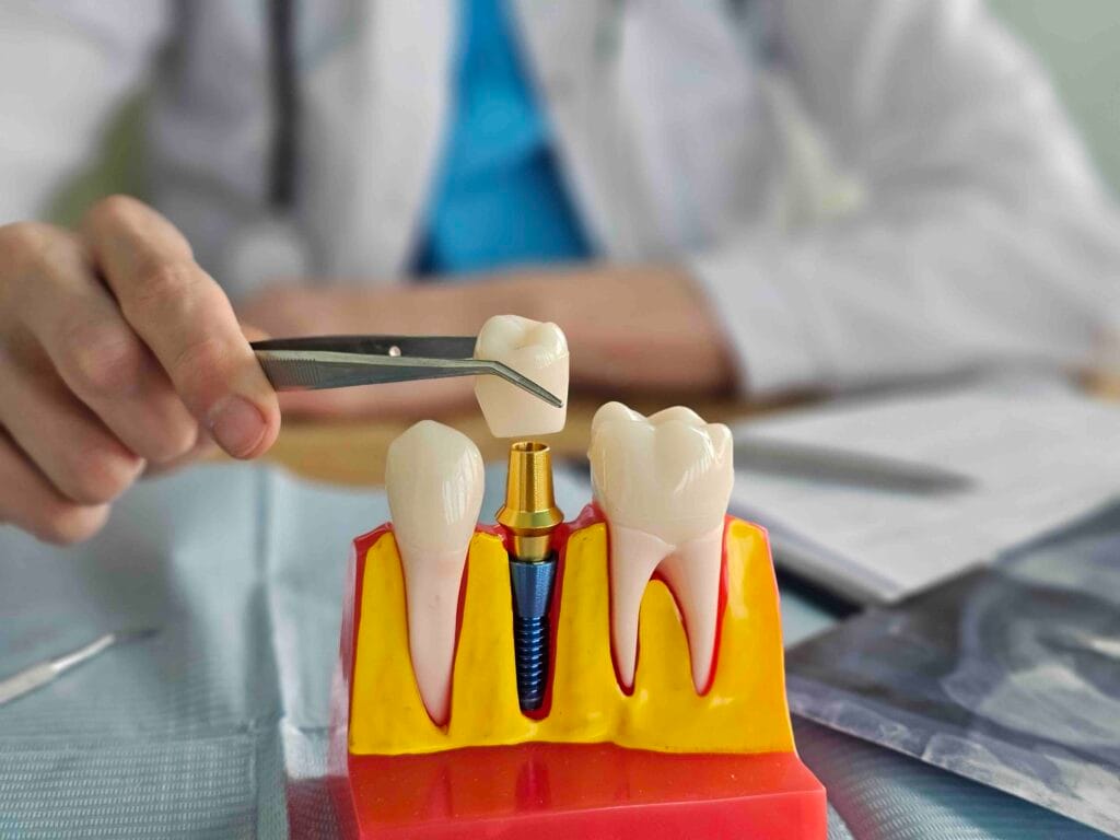 Tipi di impianti dentali oggi