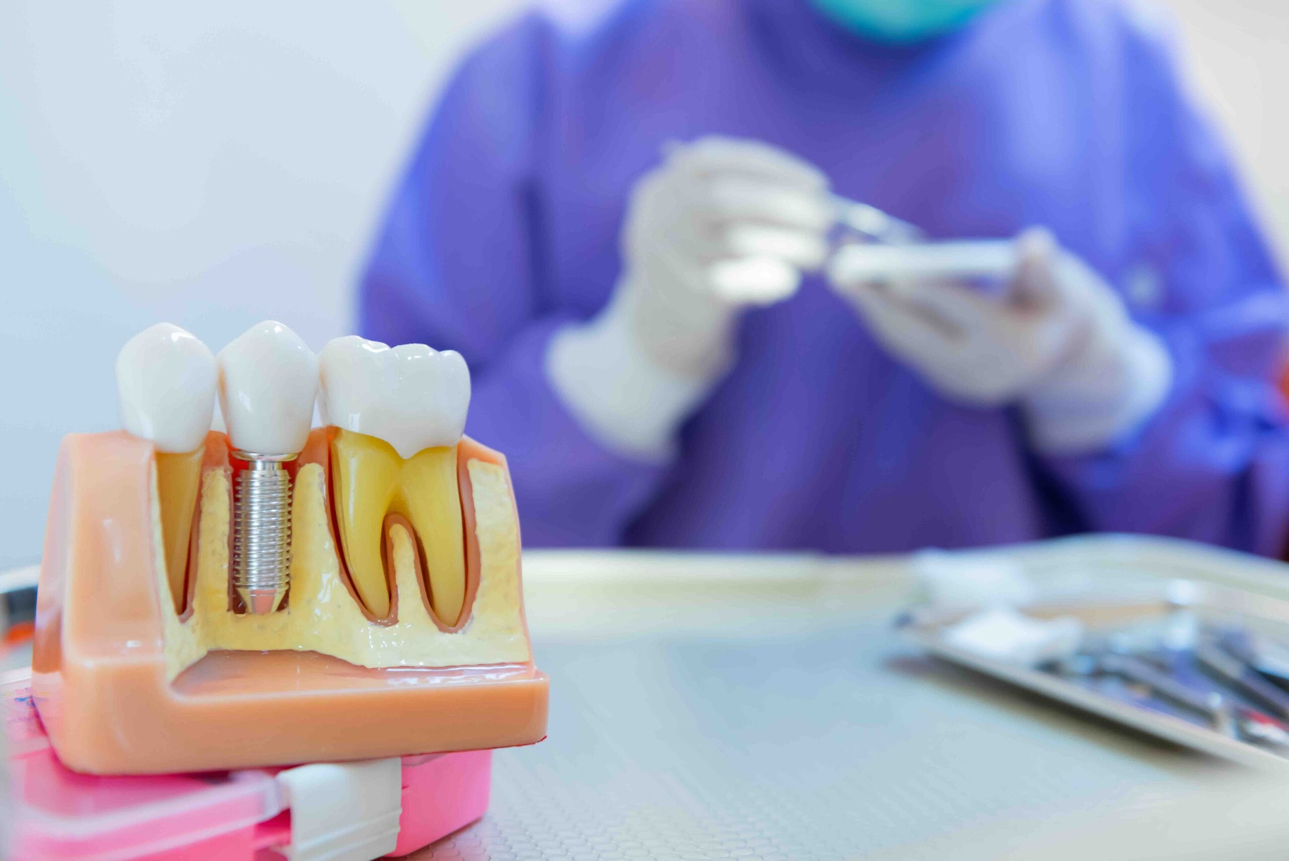 impianto dentale singolo