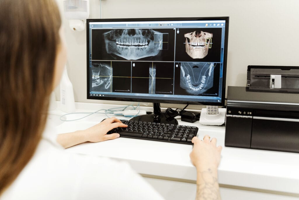 Impianto con chirurgia computer guidata