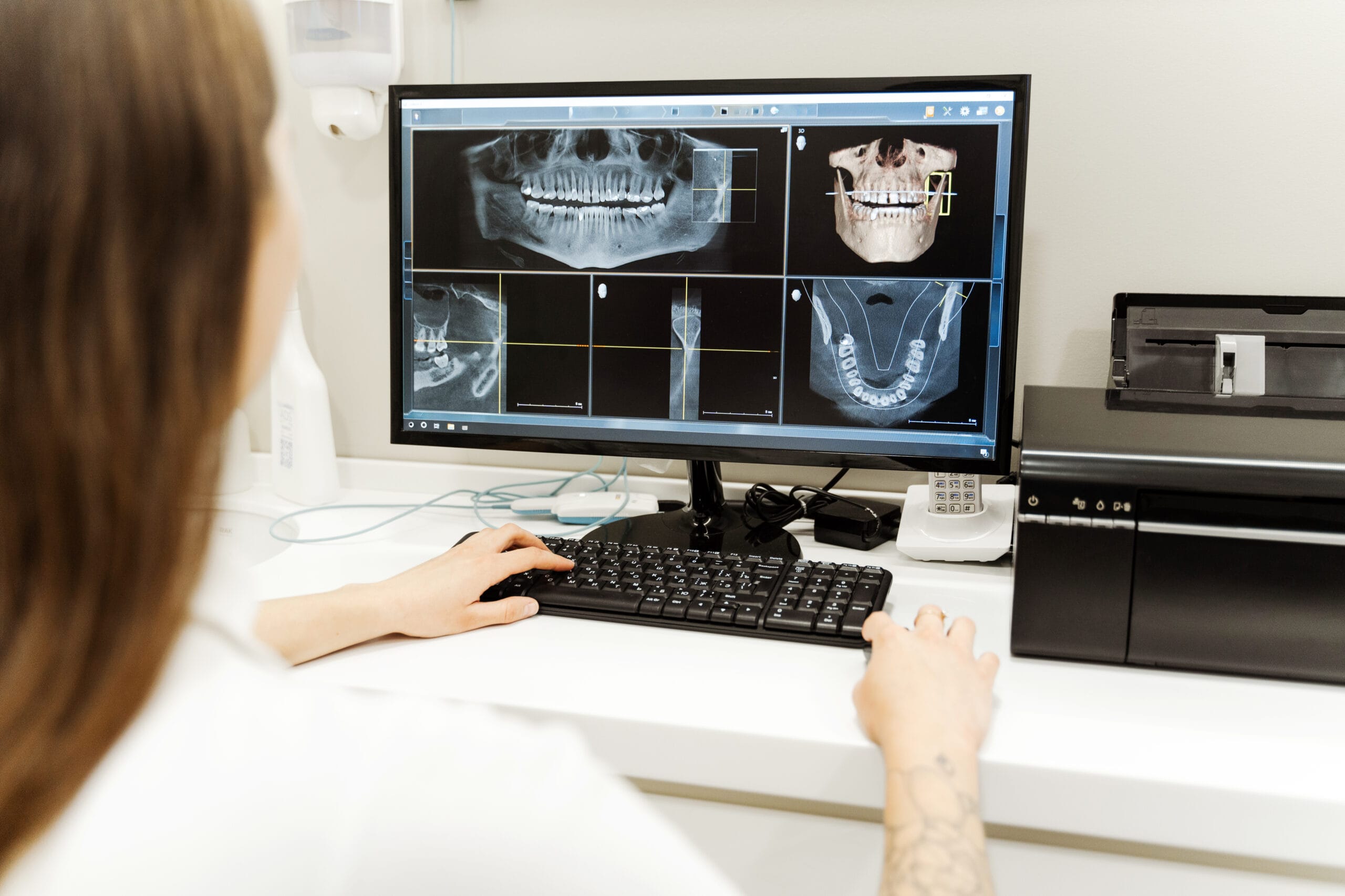 Impianto con chirurgia computer guidata