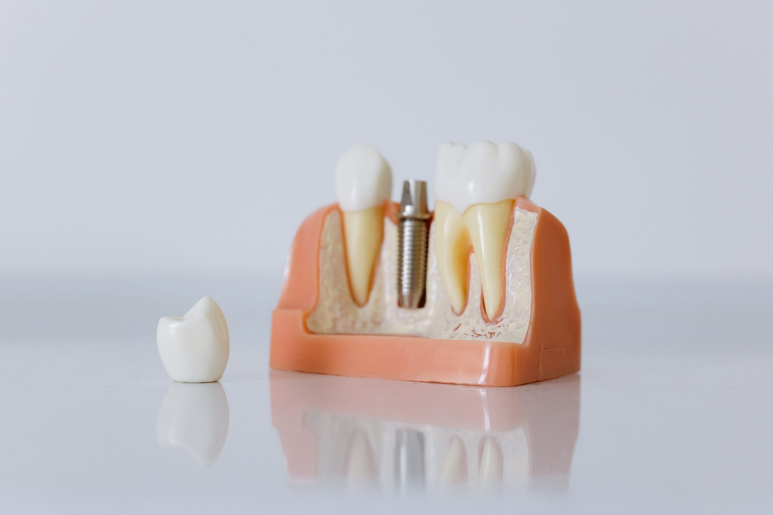 Impianto dentale davanti